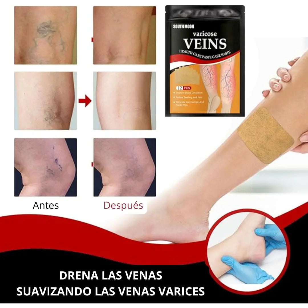 Varicose Veins