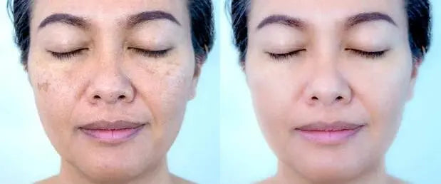 Aloe Vera + Acido Hialurónico + Vitamina E - ELYVIA